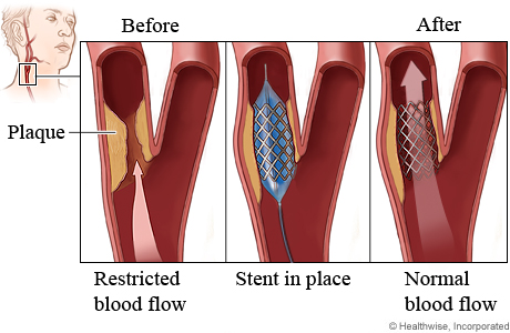 HVI Carotid Angioplasty